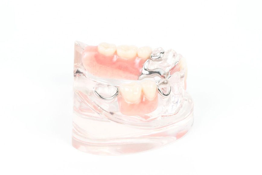 Teilprothese Klammer Gaumenfrei